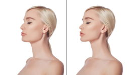 Rhinoplasty