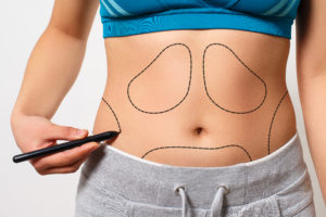 Liposuction/Liposculpture